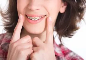 How-Much-Do-Braces-Cost-Monthly