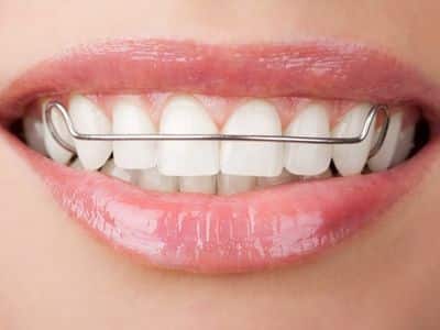 Retainers After Braces