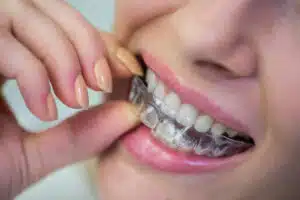 Invisalign Cost