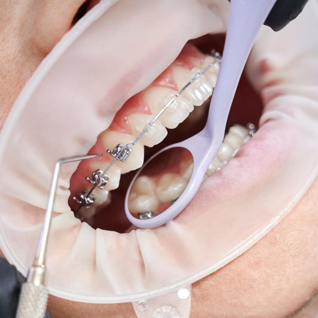 Metal vs Ceramic Braces