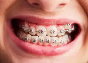 Metal Vs Ceramic Braces: Which One Is Best For You?