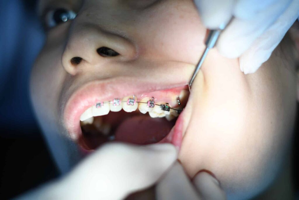 Braces Careers: Essential Advice for Professionals with Braces