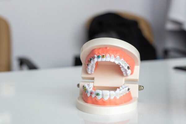 Different Types and Benefits of Braces Explained Clearly