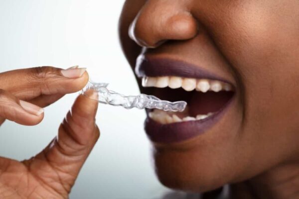 How Invisalign Works: A Complete Step-by-Step Guide