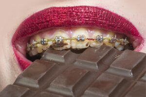 Foods to Avoid with Braces: Expert Advice for Best Results