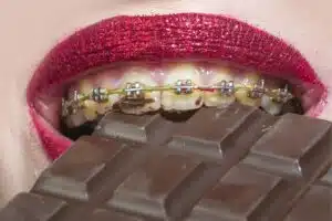 Foods with Braces