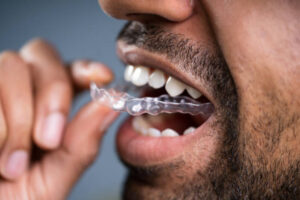 10 Reasons to Choose Invisalign: Ultimate Smile Treatment