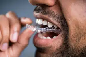 Invisalign vs Traditional Braces: Expert Insight to Help You Decide