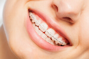 Metal Braces