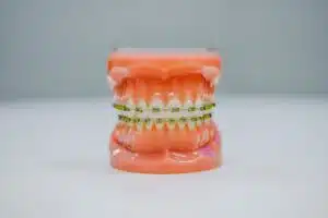 Different Types of Dental Braces: Princeton & Hillsborough Guide