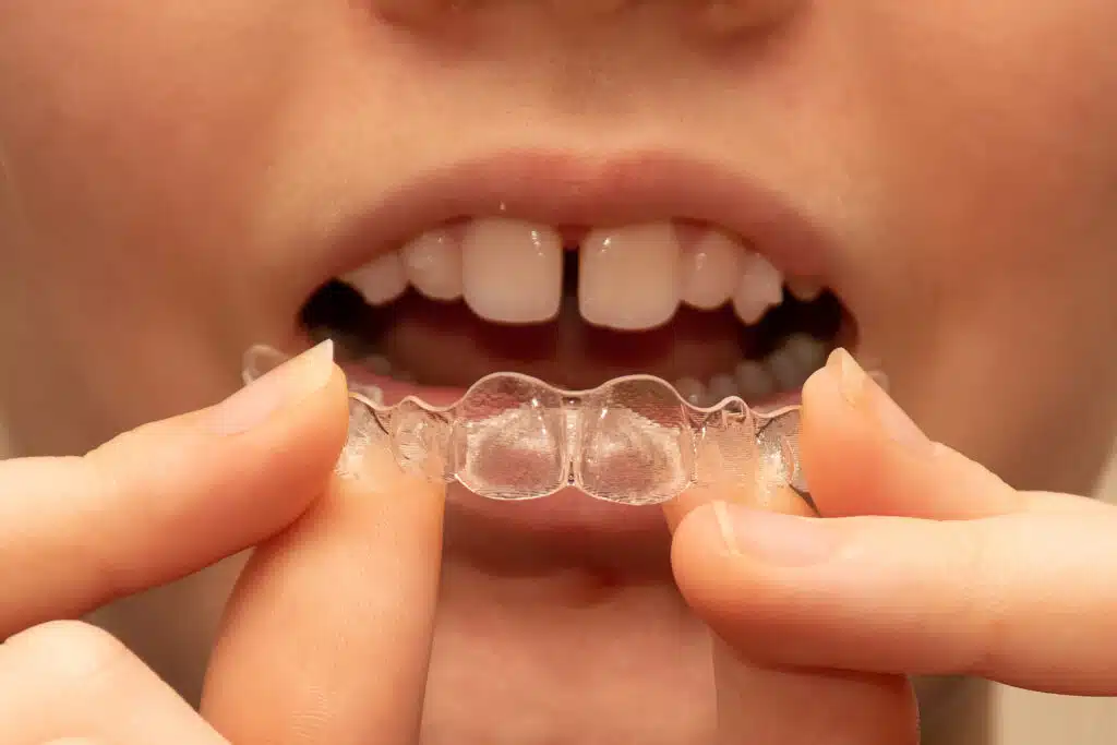 Teen holding her clear Invisalign aligners