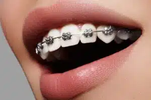 How long do braces take to straighten teeth?