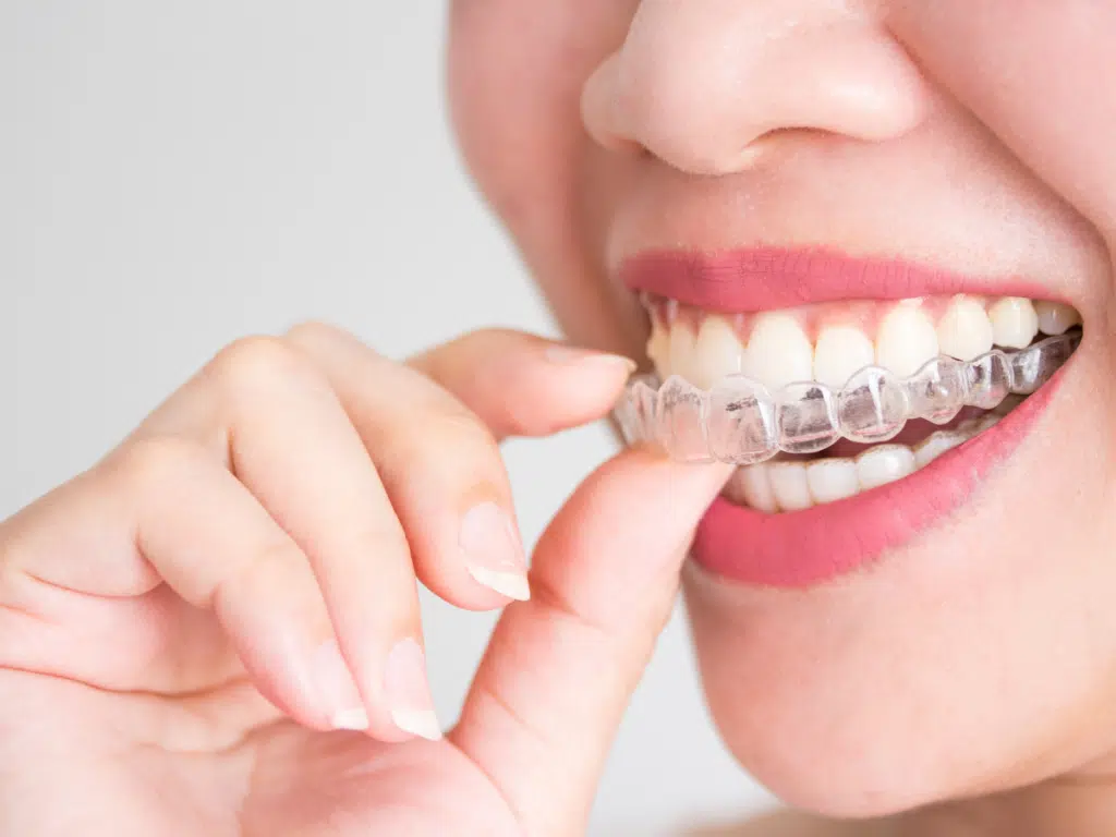 Is Invisalign Teen worth it?