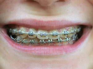 Why metal braces are still the most effective