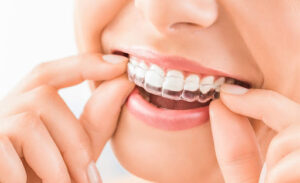 How long should you wear your Invisalign