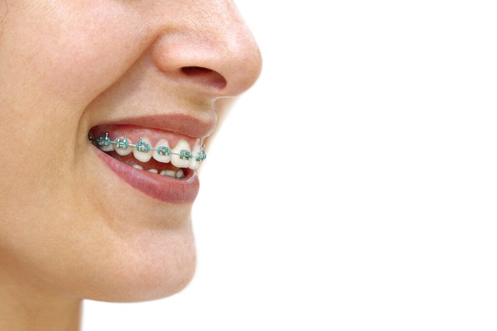 Teen smiling with braces near Lawrenceville NJ